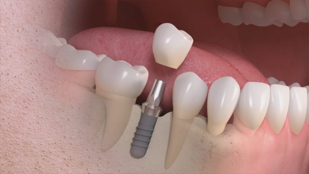 Implantologia dentale low cost prezzi Milano